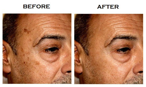 Photo-Retouching